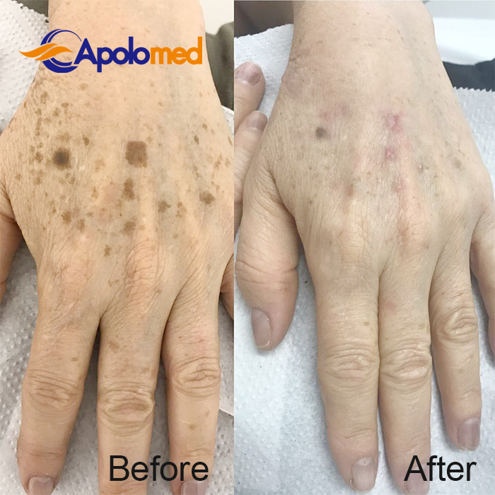 Q-Swithced Nd YAG Lasermaschine vorher nachher