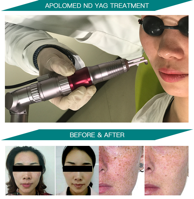 HS-298 Vorher Nachher Foto