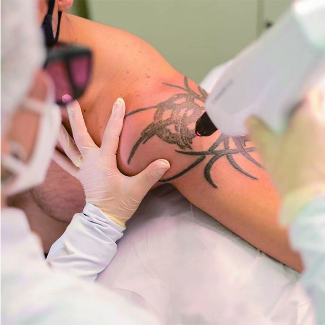 Warum ist Tattoo -Laserentfernung so teuer?
