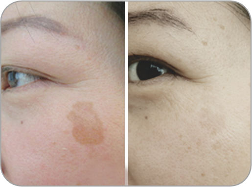 Vorher und Nachher 2