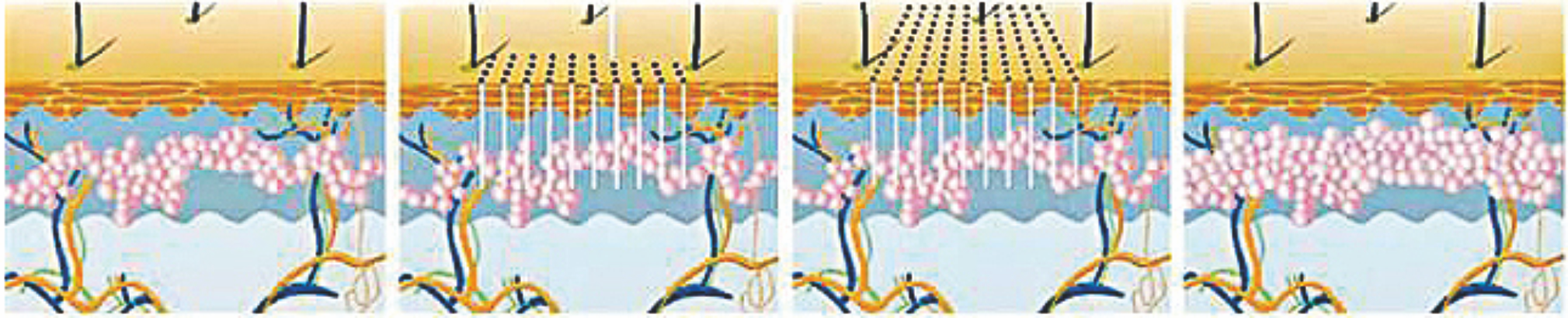 1550-nm-Erbium-Faserlaser ----Tiefenremodellierung